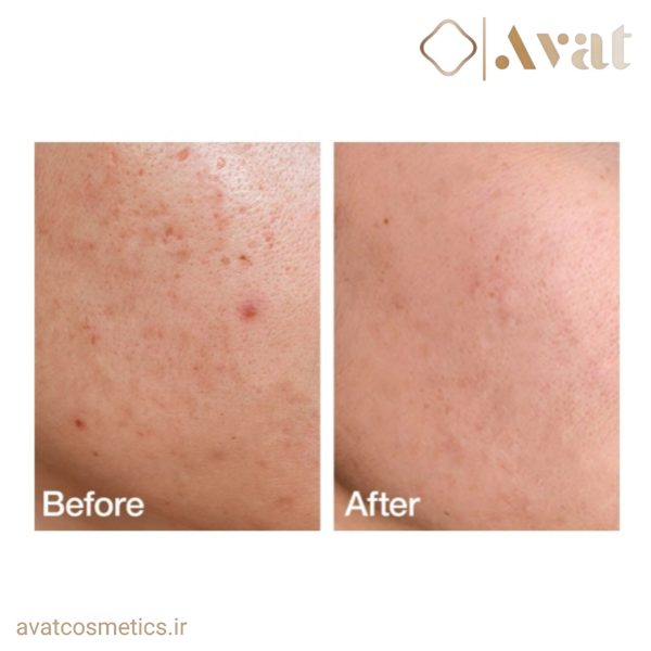 تونر آنوا