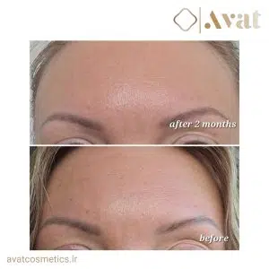 سرم آرژیرلین اوردینری