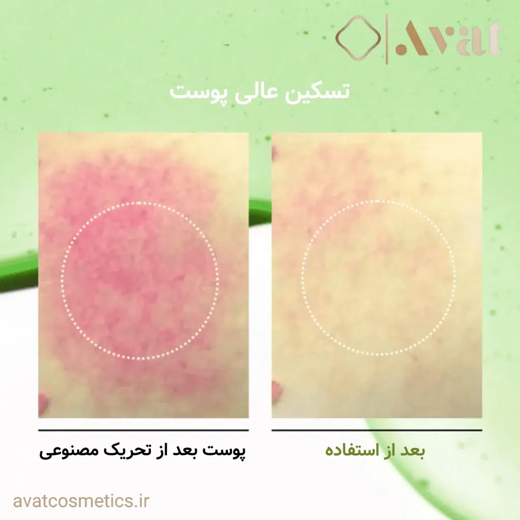 ANUA Azelaic Acid 10+ Hyaluron، کاهش لک‌های ناشی از التهابات پوستی