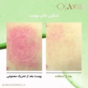 ANUA Azelaic Acid 10+ Hyaluron، کاهش لک‌های ناشی از التهابات پوستی