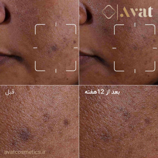 سرم Even Better کلینیک برای کاهش انواع لک و تیرگی‌های پوستی