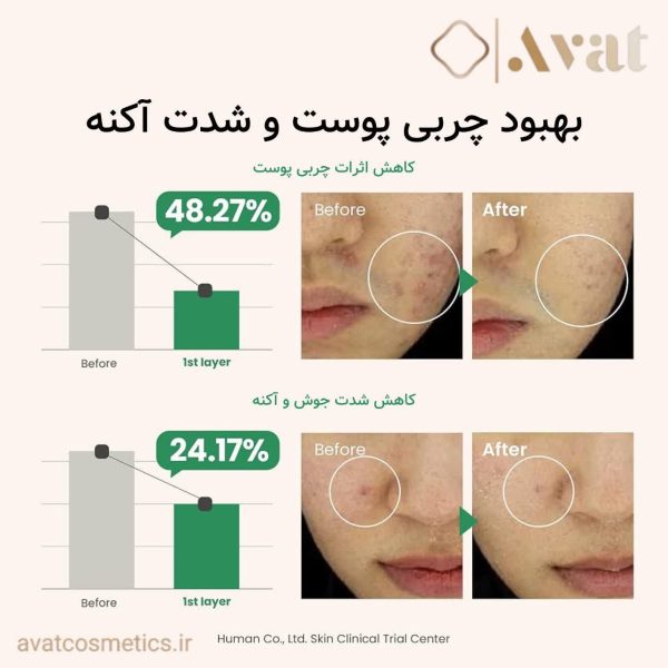 سرم ضد جوش و ضد لک اکسیس وای