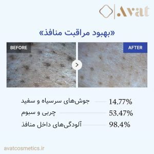 ماسک کنترل منافذ زیرو مدیکیوب