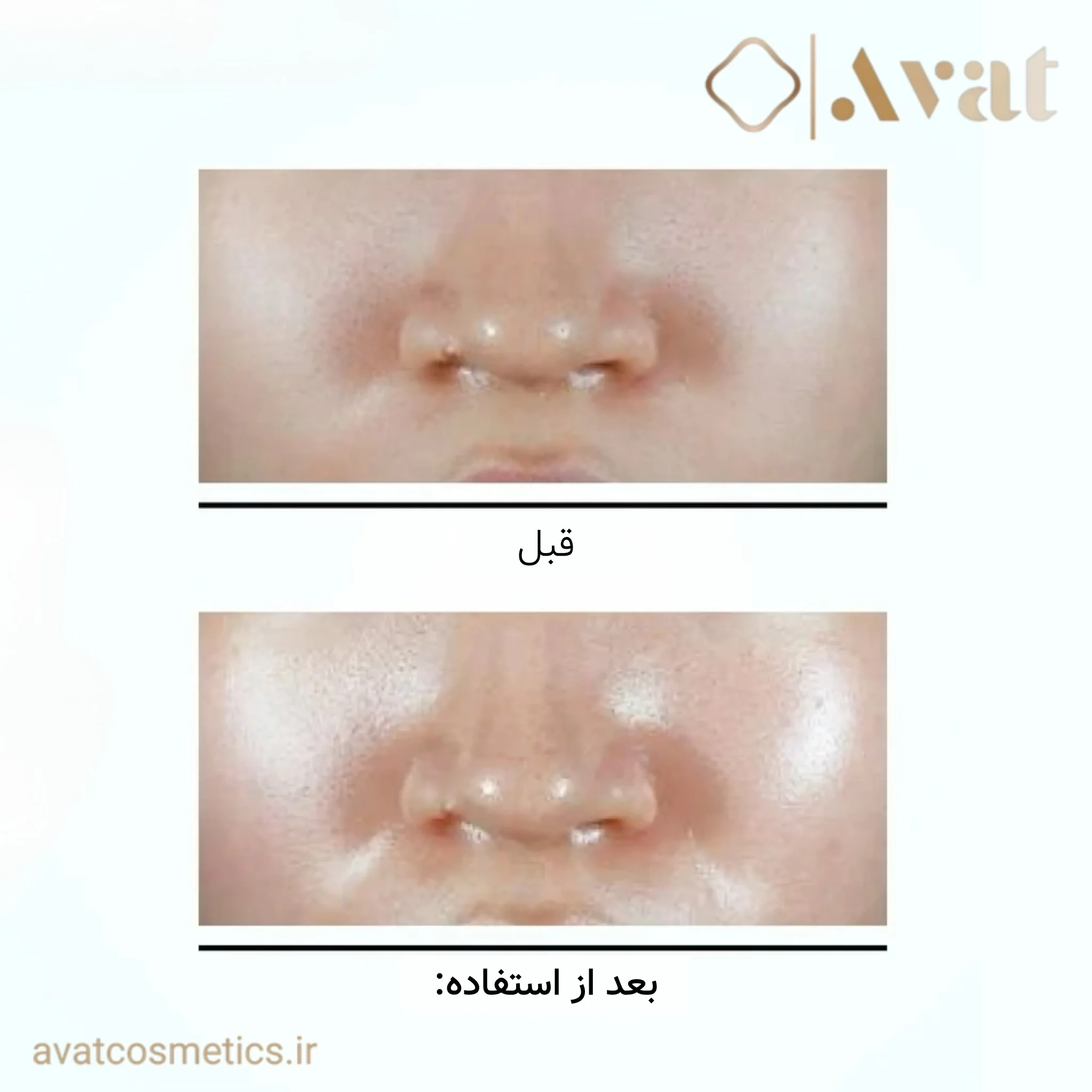 میست کپسولی PDRN و هیالورونیک آنوا
