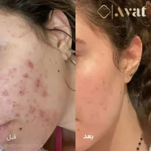 فوم شستشوی ضدجوش پانوکسیل